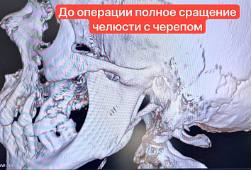 Врачи горбольницы №5 провели уникальную операцию по восстановлению челюсти